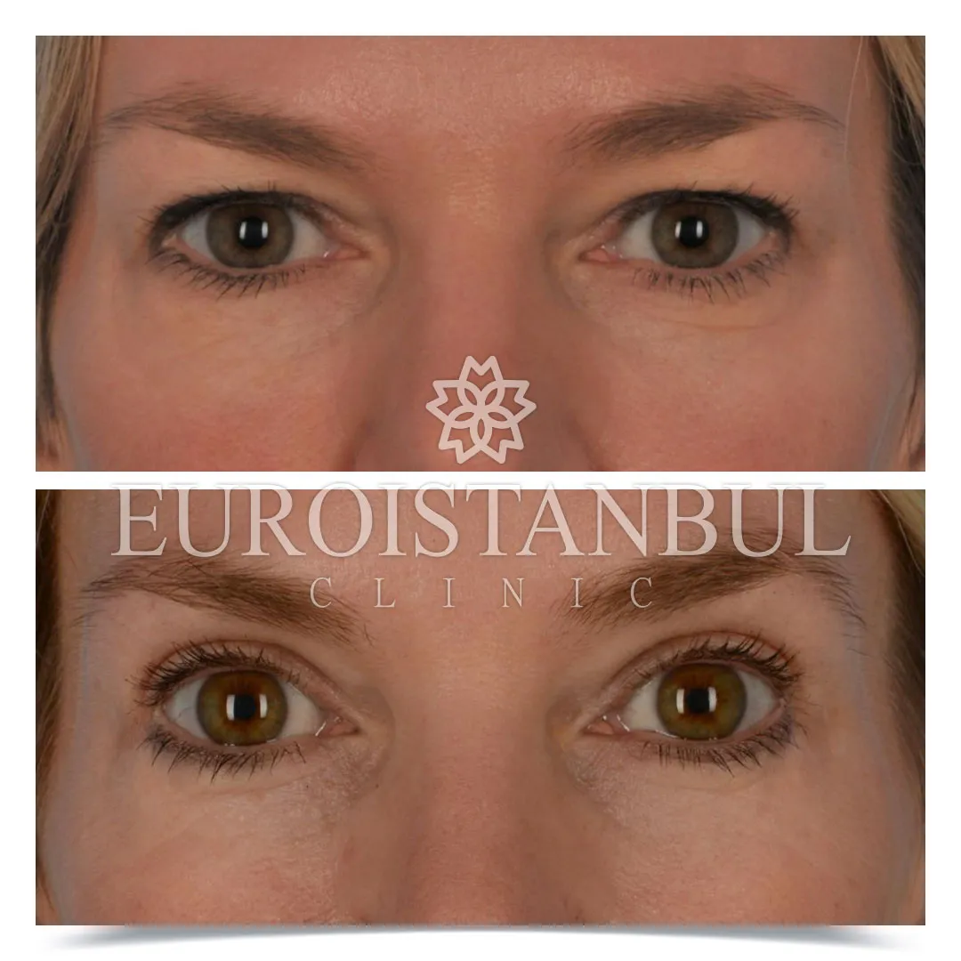 Blepharoplasty Before After Photos