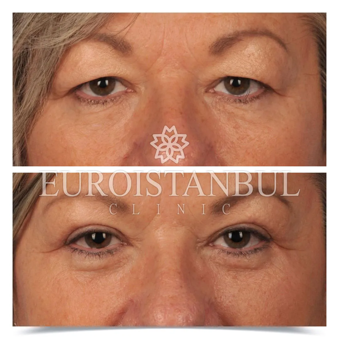 Blepharoplasty Before After Photos