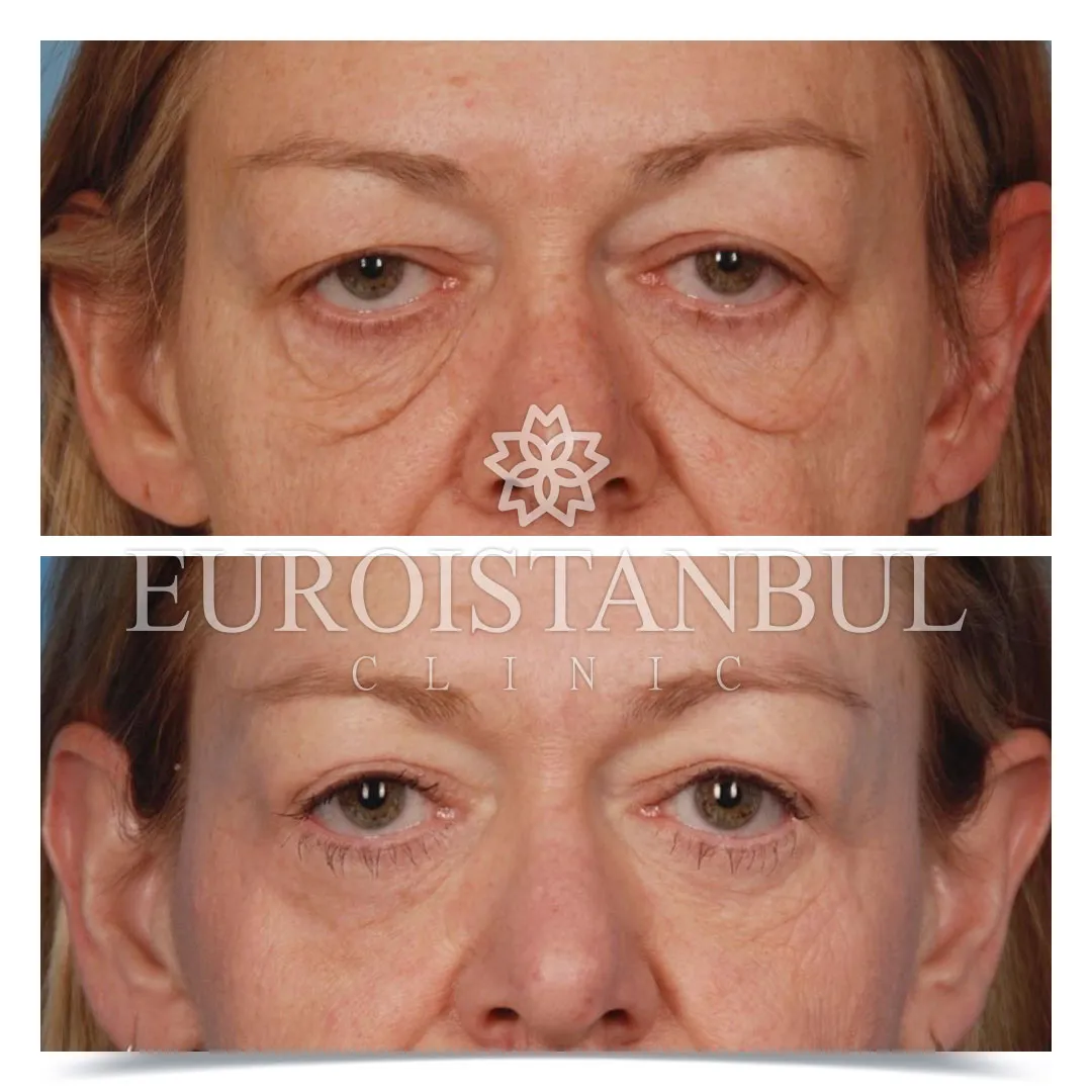 Blepharoplasty Before After Photos