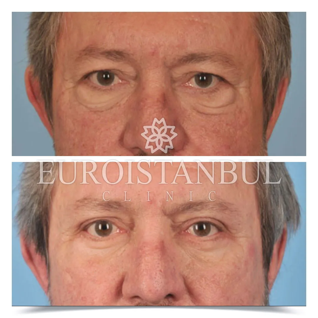Blepharoplasty Before After Photos