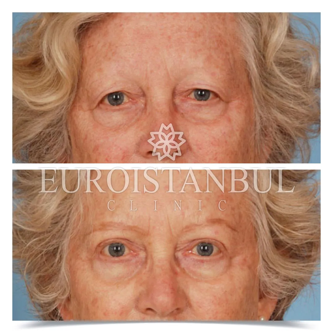 Blepharoplasty Before After Photos