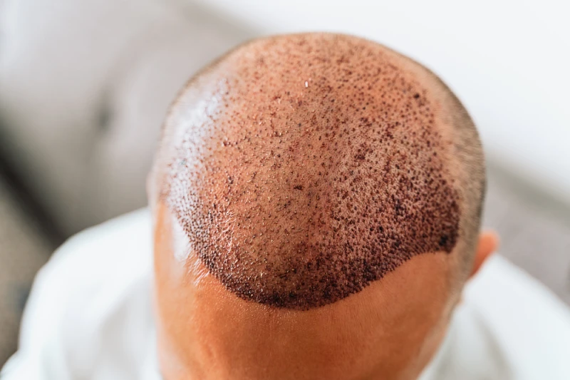 after-hybrid-hair-transplantation-surgical-technique https://www.euroistanbul.com/wp-content/uploads/after-hybrid-hair-transplantation-surgical-technique.webp