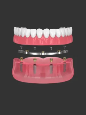 https://www.euroistanbul.com/wp-content/uploads/all-on-4-titanium-bar-hybrid-dental-implant-300x400.webp