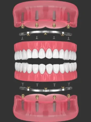 https://www.euroistanbul.com/wp-content/uploads/all-on-4-titanium-bar-hybrid-dental-implant-full-300x400.webp