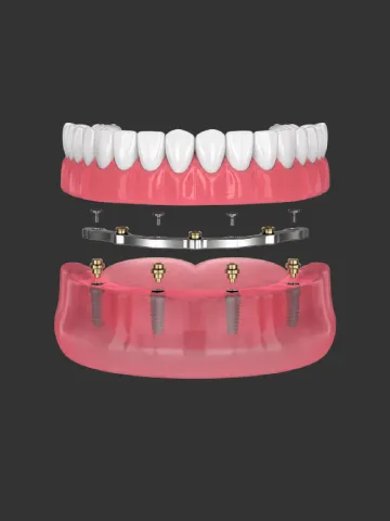 all-on-4-titanium-bar-hybrid-dental-implant https://www.euroistanbul.com/wp-content/uploads/all-on-4-titanium-bar-hybrid-dental-implant.webp