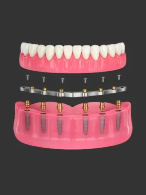 all-on-6-titanium-bar-hybrid-dental-implant https://www.euroistanbul.com/wp-content/uploads/all-on-6-titanium-bar-hybrid-dental-implant-1-300x400.webp