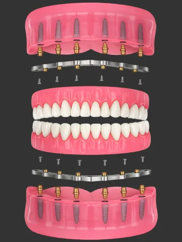 all-on-6-titanium-bar-hybrid-dental-implant-full https://www.euroistanbul.com/wp-content/uploads/all-on-6-titanium-bar-hybrid-dental-implant-full-1-300x400.webp