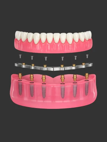 all-on-6-titanium-bar-hybrid-dental-implant https://www.euroistanbul.com/wp-content/uploads/all-on-6-titanium-bar-hybrid-dental-implant.webp