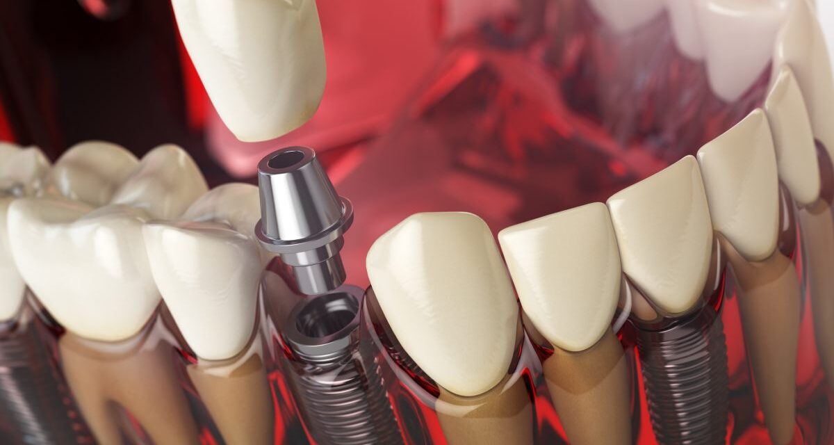 Merker av Tannimplantater