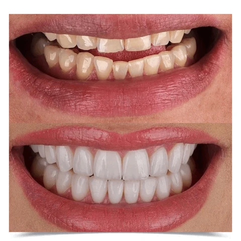 teeth-before-after